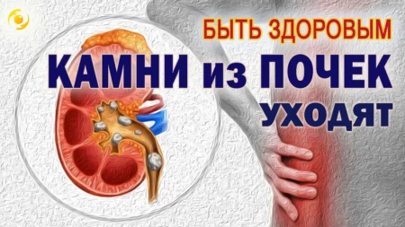 ОТЗЫВ. КАМНИ из почек УХОДЯТ!!! Помогают МИКРОСФЕРЫ